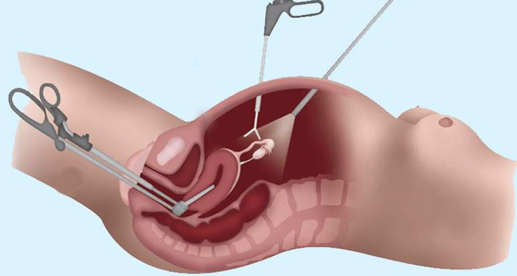 Laparoscopic Hysterectomy Treatment in Noida