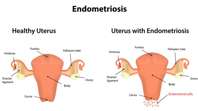 Endometriosis Treatment in Greater Noida