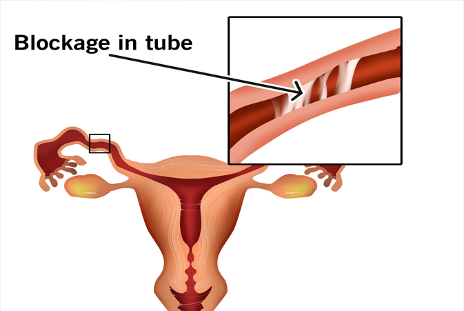 Blocked Fallopian Tubes Treatment in Noida