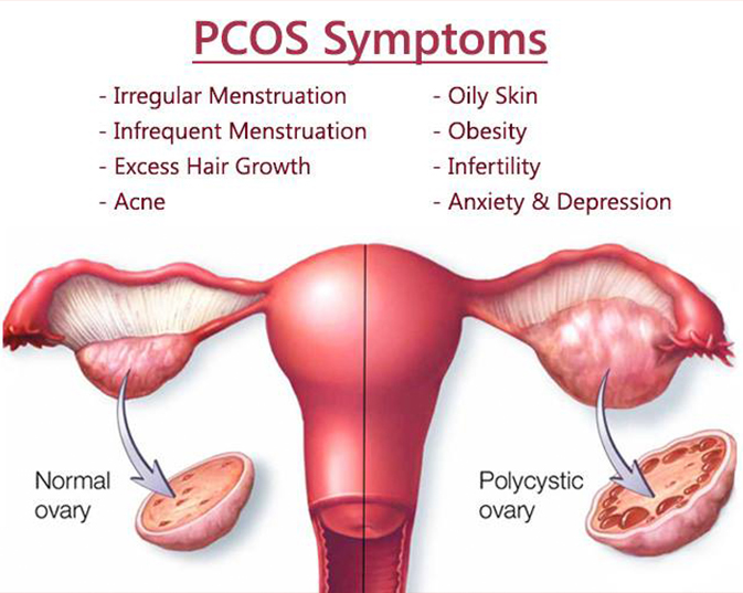 Pcos Treatment in Greater Noida